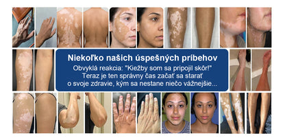 🌿Laleia® Piperín Repigmentačný aktivačný sprej