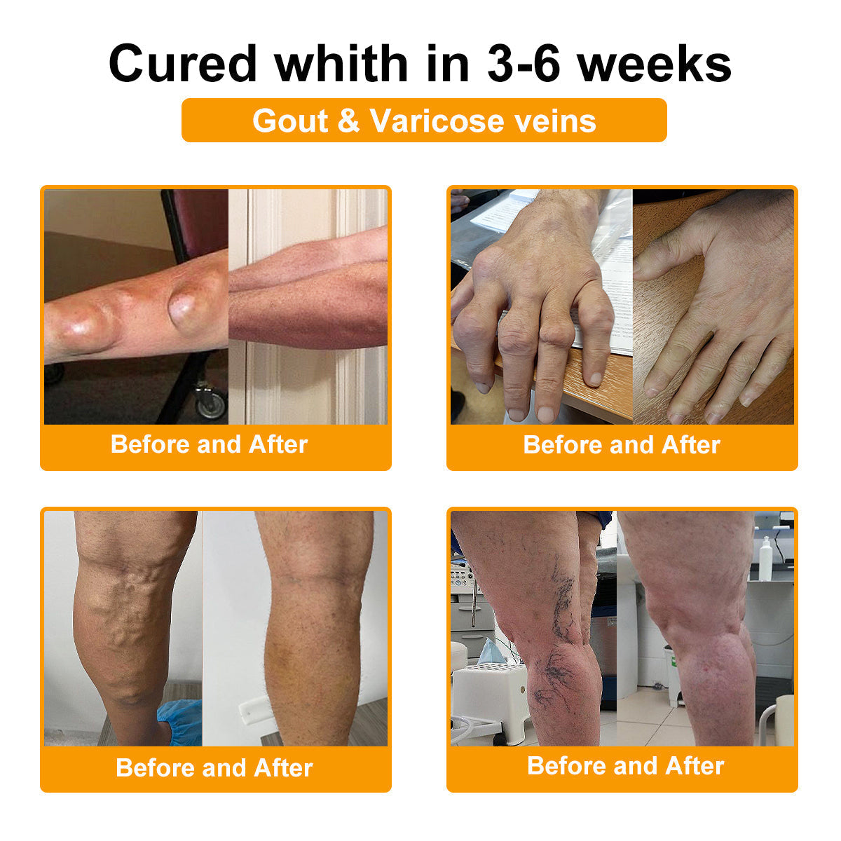 Buzora® Botulinum Toxin és Méhméreg Fájdalomcsillapító Csontgyógyító Krém🌿