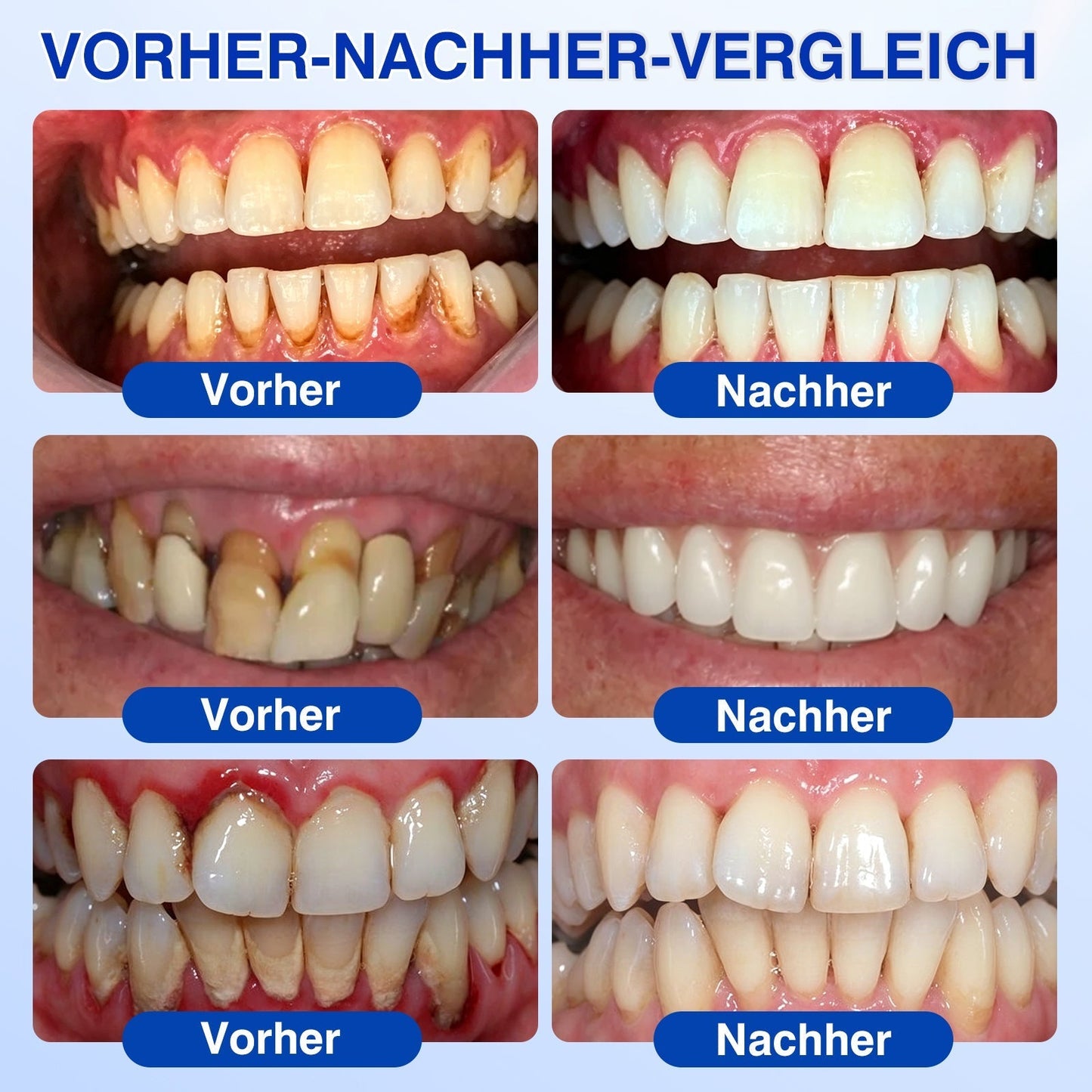 CleraNaure®💎 GumRevive – fejlett gél az íny és a fogágy ápolására🇭🇺👨‍⚕️✅🦷