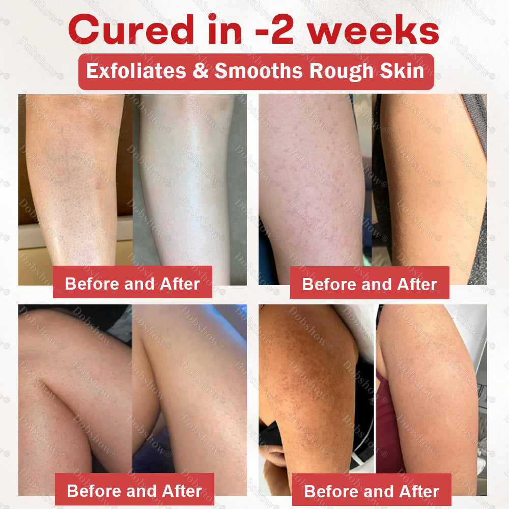 🎉Limited-time discount✨CleraNaure® Salicylic Acid Keratosis Spray | keratosis pilaris on arms & body