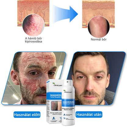 🏆CleraNature® Magnéziumos Spray – Gyors Enyhülés Viszkető, Vörös és Érzékeny Bőrre (Még Intim Területeken is)🏆