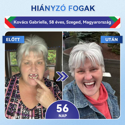 🦷CleraNaure® Tideglusib Fog & íny Javító mikrotűs tapasz | Fejlett őssejt-aktiváló fogcsíkok (újjáépíti a fogzománcot és a dentint • erősíti az ínyt • megszünteti a fogkövet és a szagokat • megállítja a fogérzékenységet) 3.0