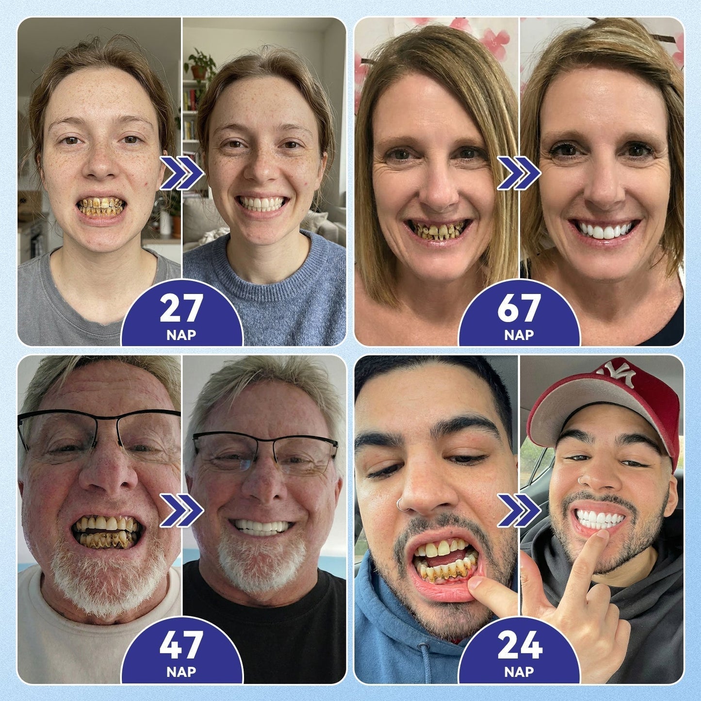 🦷CleraNaure® Tideglusib Fog & íny Javító mikrotűs tapasz | Fejlett őssejt-aktiváló fogcsíkok (újjáépíti a fogzománcot és a dentint • erősíti az ínyt • megszünteti a fogkövet és a szagokat • megállítja a fogérzékenységet) 3.0
