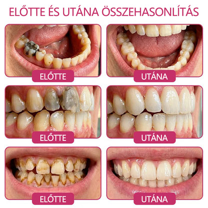CleraNaure® DenPerm Fogzománc-helyreállító Töltőgél🧡