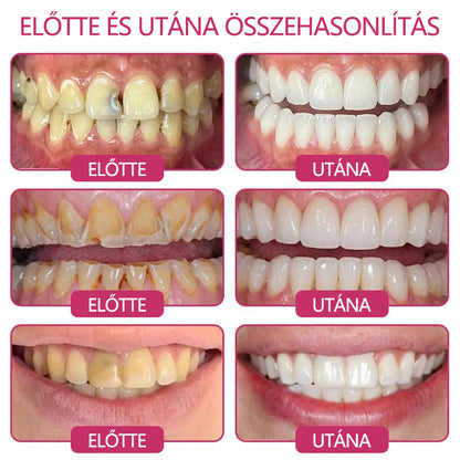 CleraNaure® DenPerm Fogzománc-helyreállító Töltőgél🧡