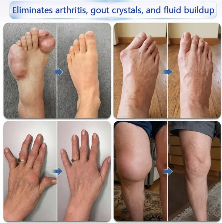 🦵 CleraNaure® Gyors Hatású Ízület- és Csonttámogató Formula ✨ Mikrotűs Ízület- és Csontregeneráló Görgő