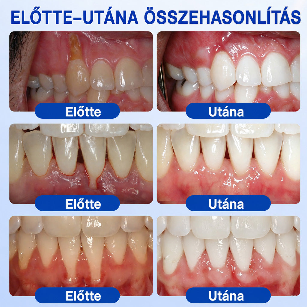 CleraNaure®💎 GumRevive – fejlett gél az íny és a fogágy ápolására🇭🇺👨‍⚕️✅🦷
